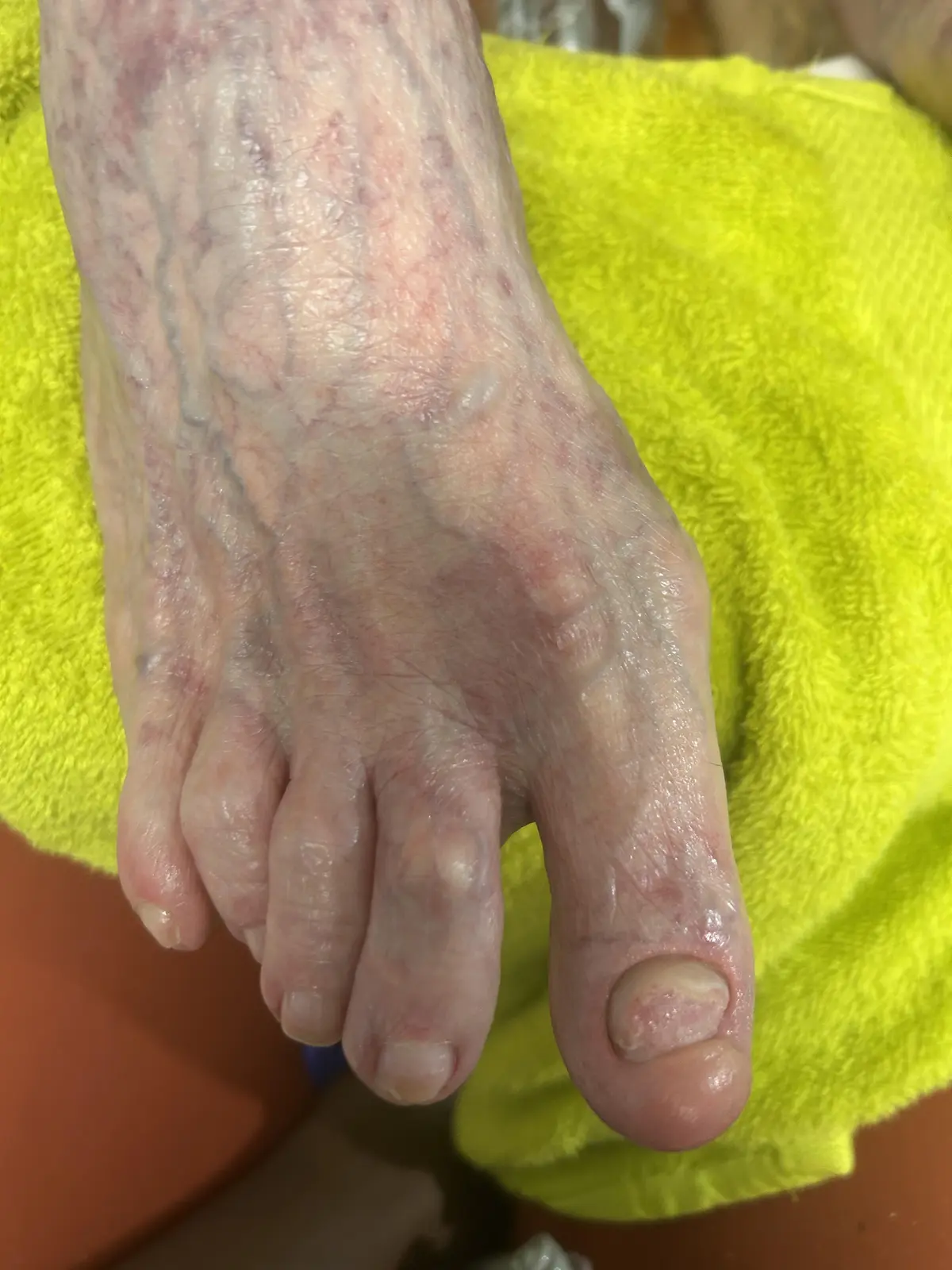 Client toenail after corrective care