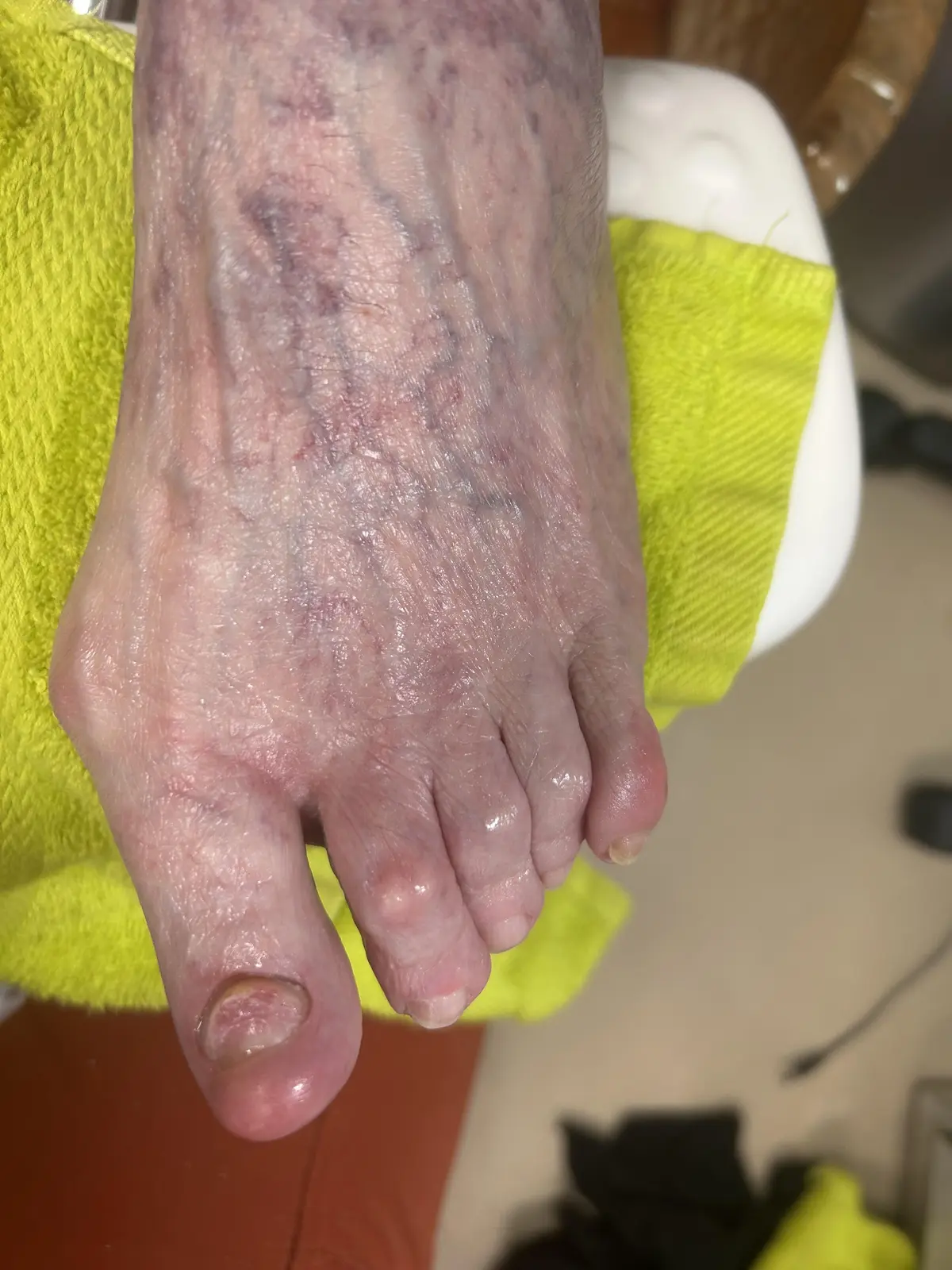 Client foot after restorative nail care
