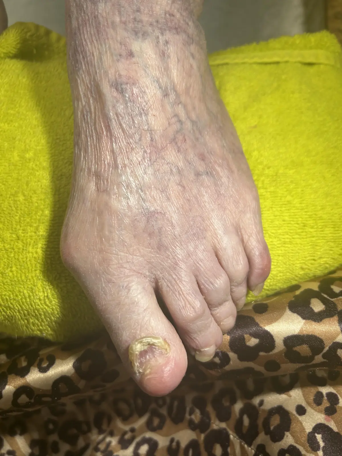Client foot before restorative nail care