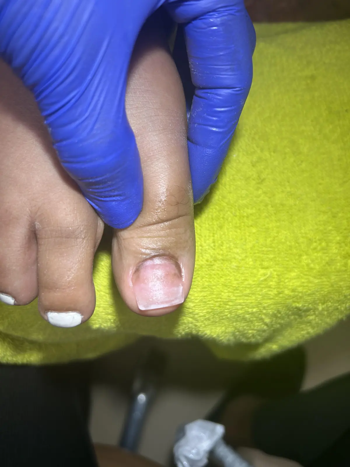 Client toenail after professional foot care