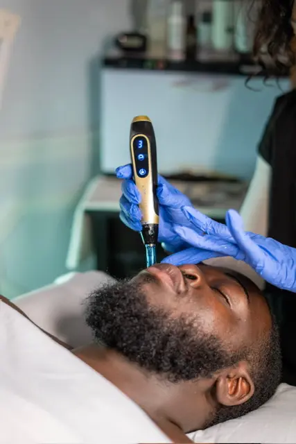 Close view of professional microneedling care at Meticulous Spa