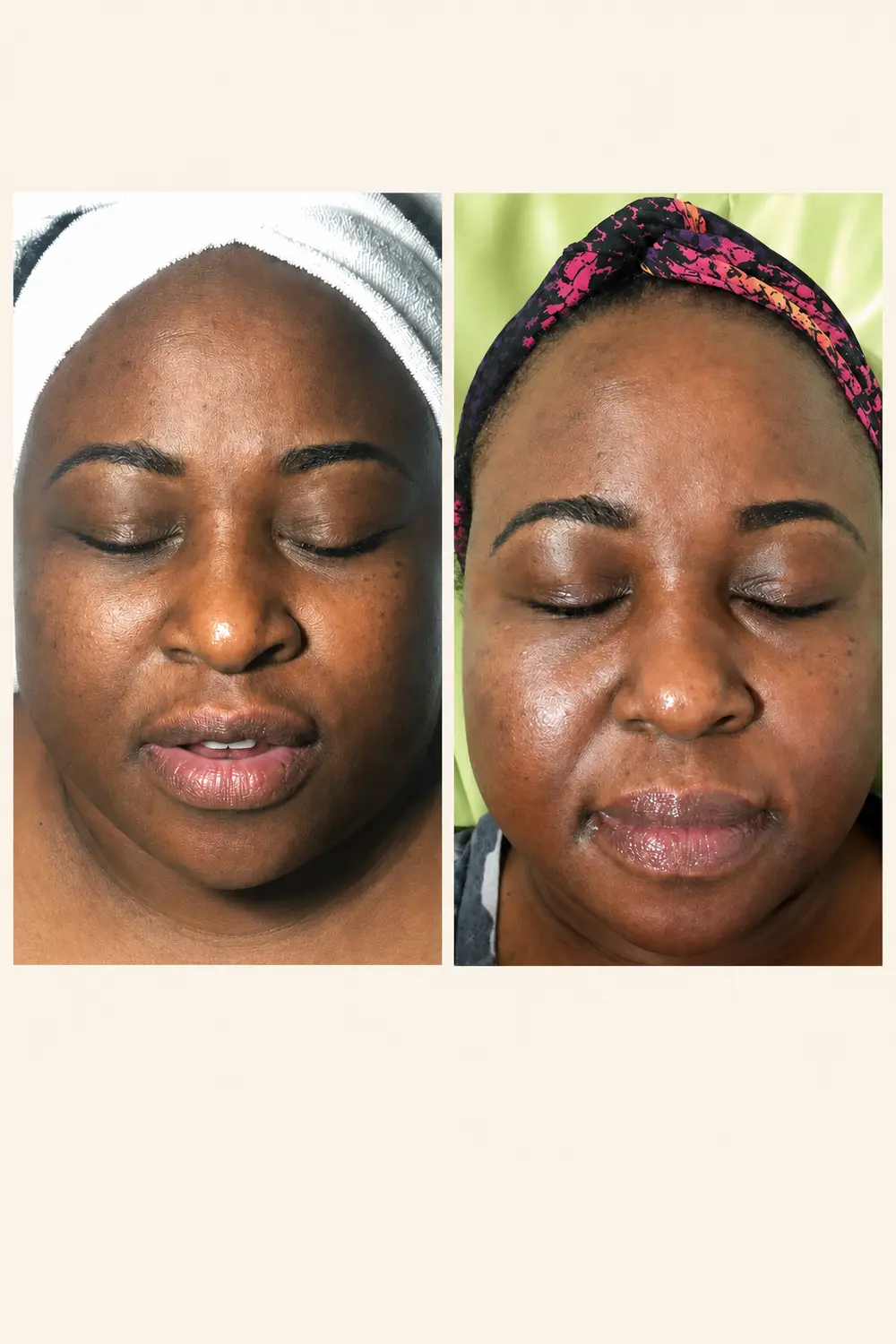 Published Meticulous Spa essential facial and chemical peel photographs